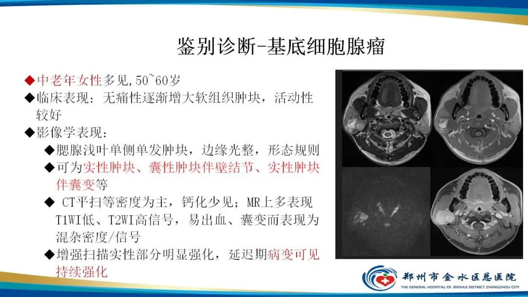 影像PPT - 【病例】腮腺多形性腺瘤1例CT影像-25