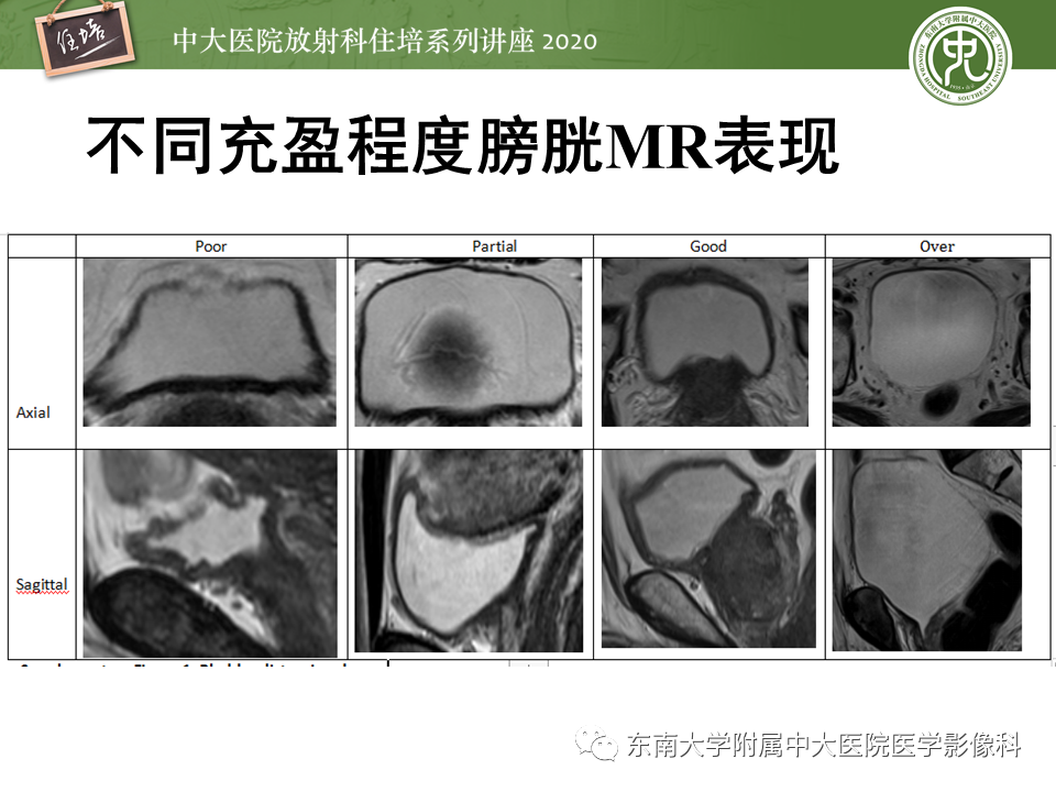 影像PPT - 【PPT】膀胱VI-RADS解读-6