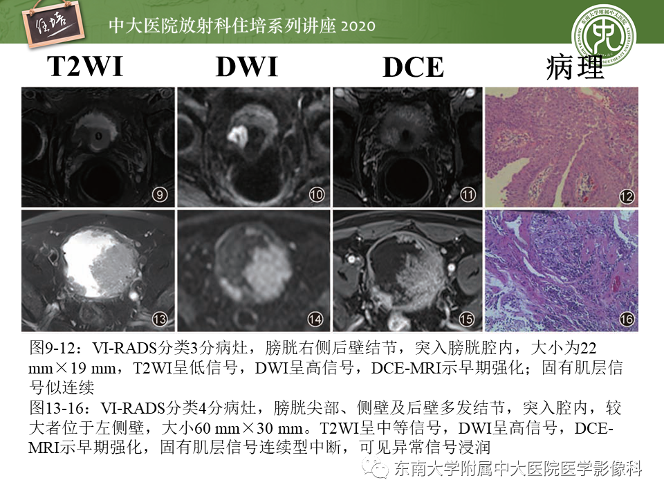 影像PPT - 【PPT】膀胱VI-RADS解读-22