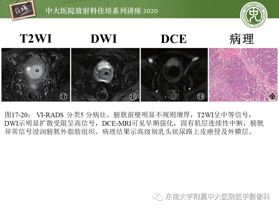 影像PPT - 【PPT】膀胱VI-RADS解读-23