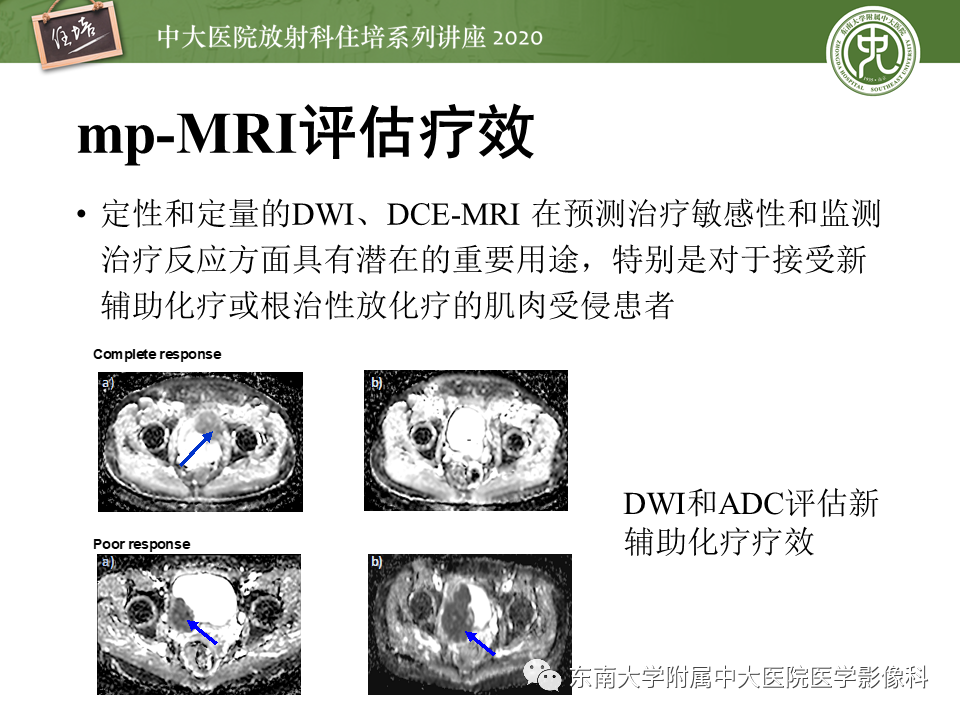 影像PPT - 【PPT】膀胱VI-RADS解读-25