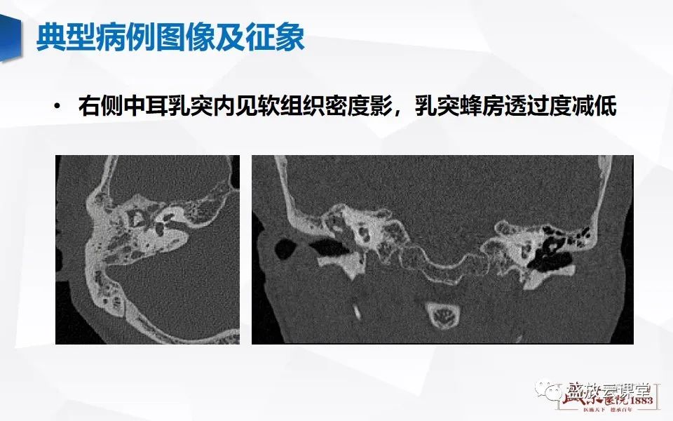 影像PPT - 【PPT】中耳乳突解剖及炎症-4