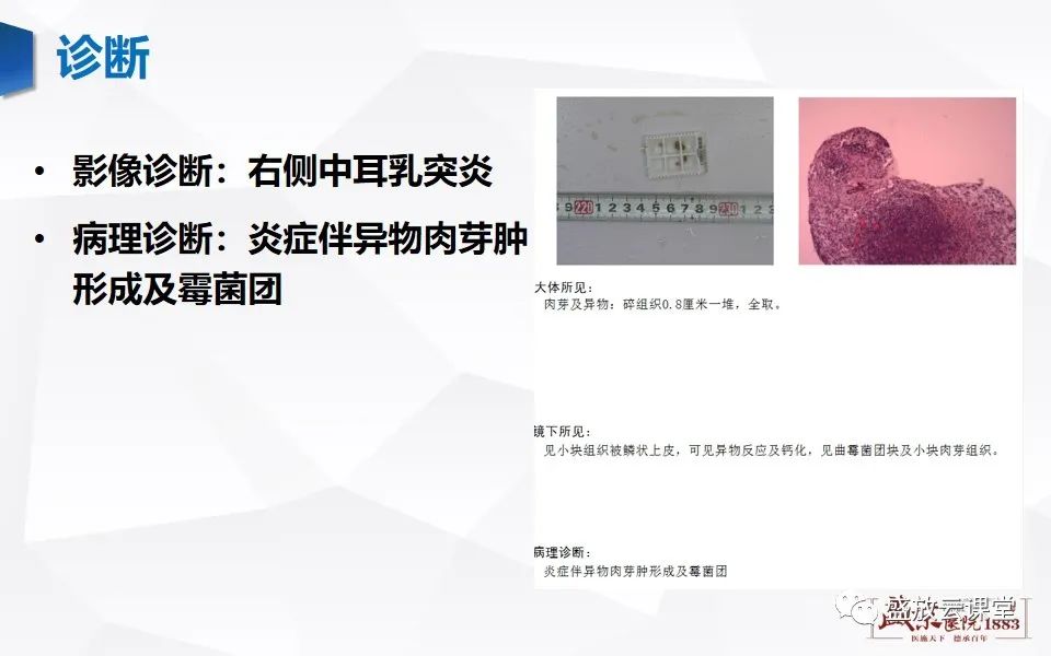 影像PPT - 【PPT】中耳乳突解剖及炎症-7