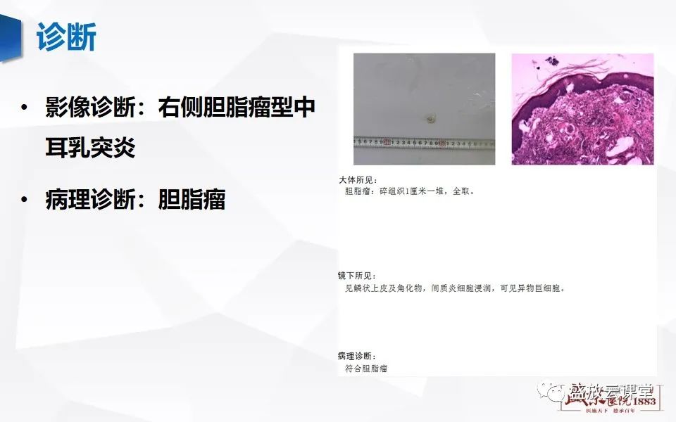 影像PPT - 【PPT】中耳乳突解剖及炎症-13