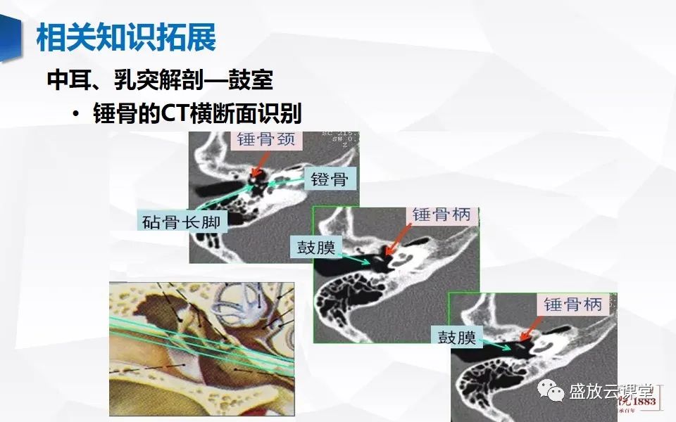 影像PPT - 【PPT】中耳乳突解剖及炎症-28