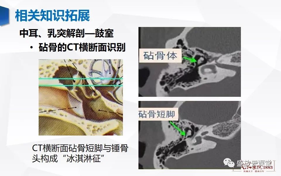 影像PPT - 【PPT】中耳乳突解剖及炎症-29