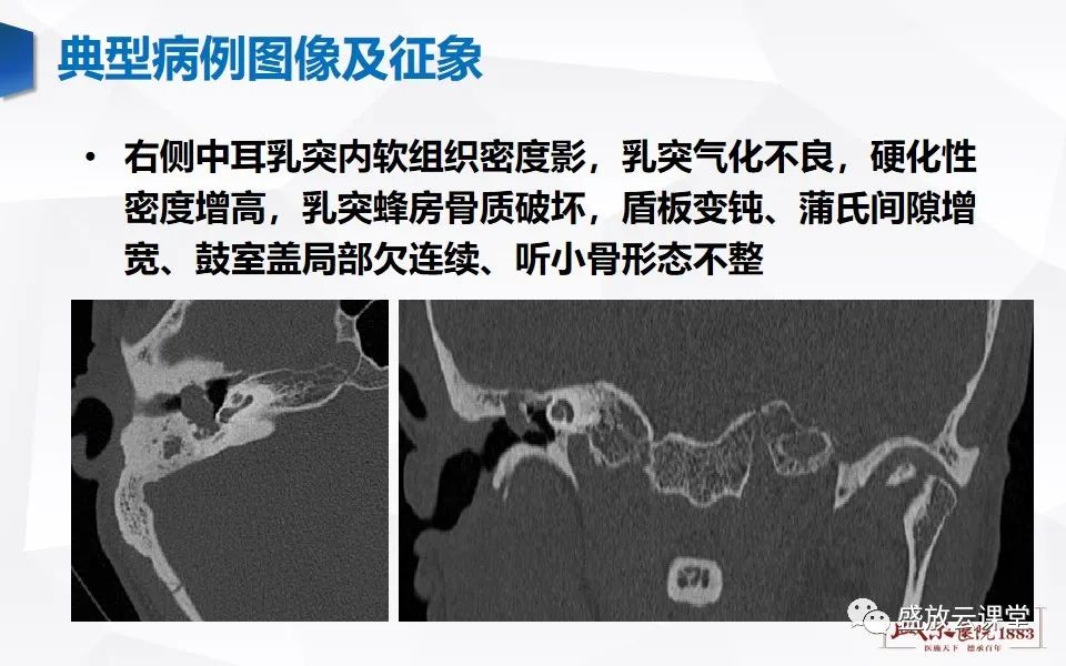 影像PPT - 【PPT】中耳乳突解剖及炎症-9