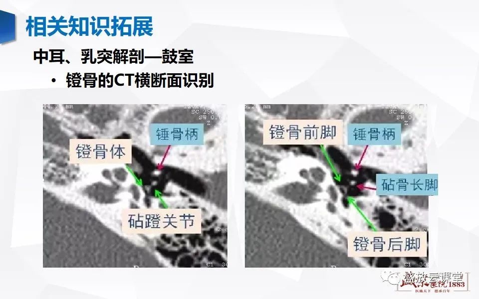 影像PPT - 【PPT】中耳乳突解剖及炎症-31