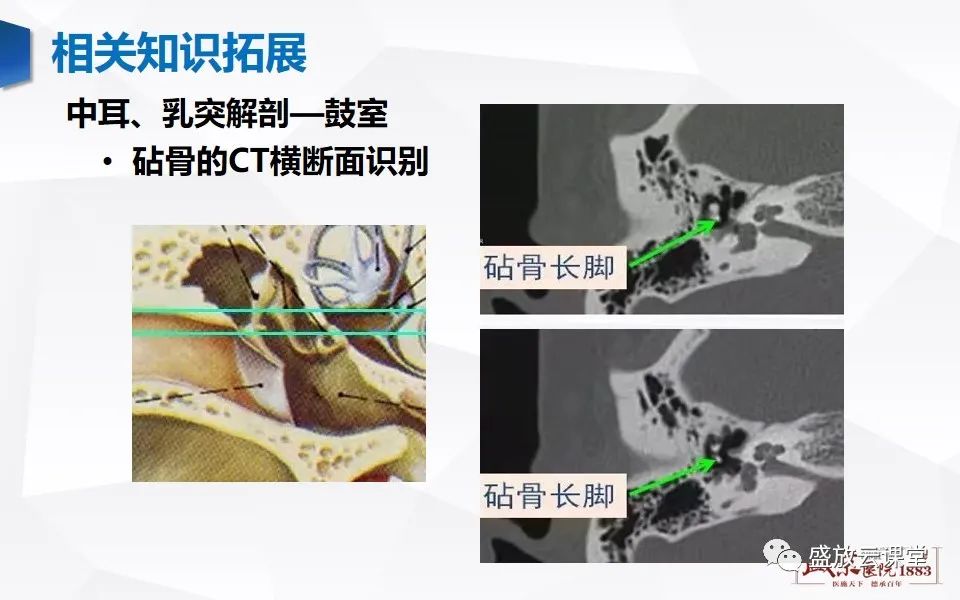 影像PPT - 【PPT】中耳乳突解剖及炎症-30