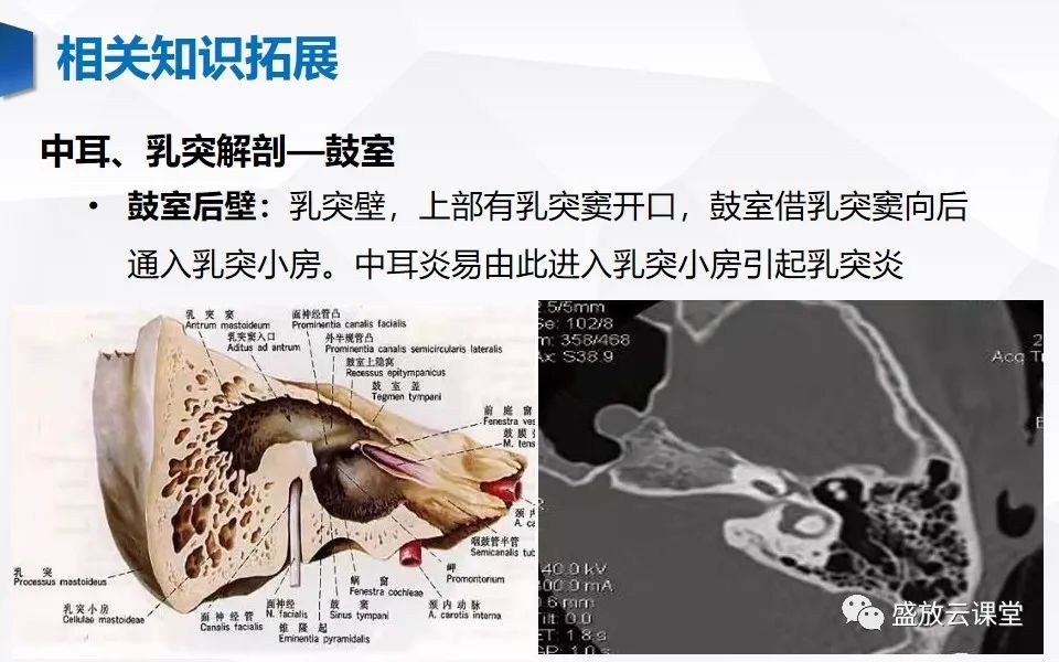 影像PPT - 【PPT】中耳乳突解剖及炎症-21