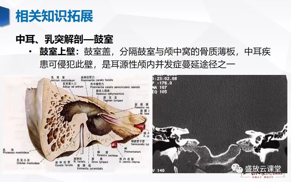 影像PPT - 【PPT】中耳乳突解剖及炎症-18