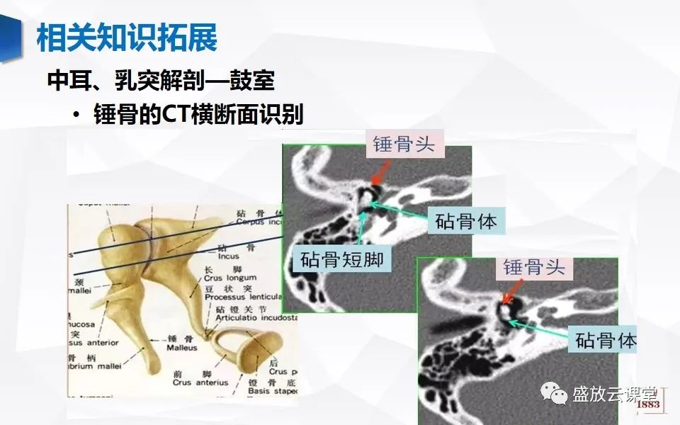 影像PPT - 【PPT】中耳乳突解剖及炎症-27