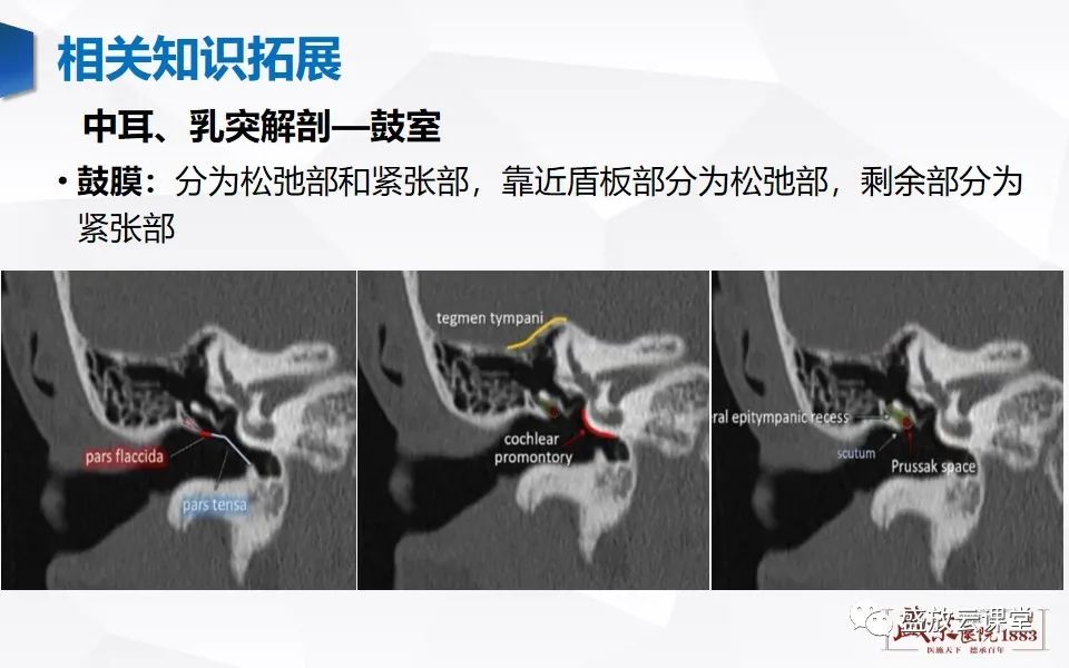 影像PPT - 【PPT】中耳乳突解剖及炎症-24