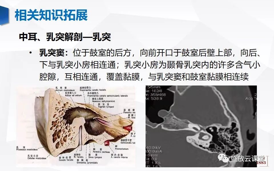 影像PPT - 【PPT】中耳乳突解剖及炎症-33