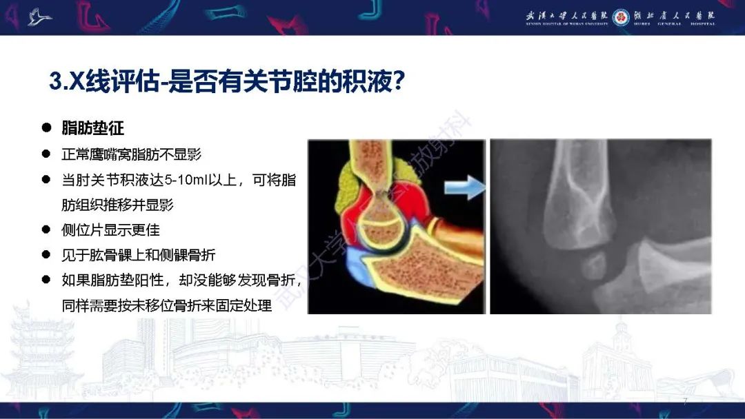 影像PPT - 【PPT】儿童肘关节外伤X线诊断-7