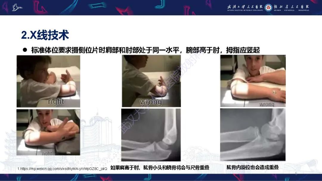 影像PPT - 【PPT】儿童肘关节外伤X线诊断-5