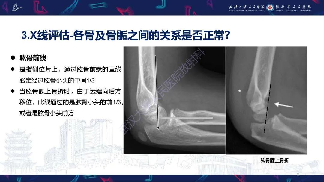 影像PPT - 【PPT】儿童肘关节外伤X线诊断-8