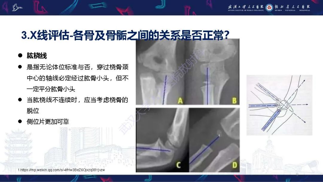 影像PPT - 【PPT】儿童肘关节外伤X线诊断-9