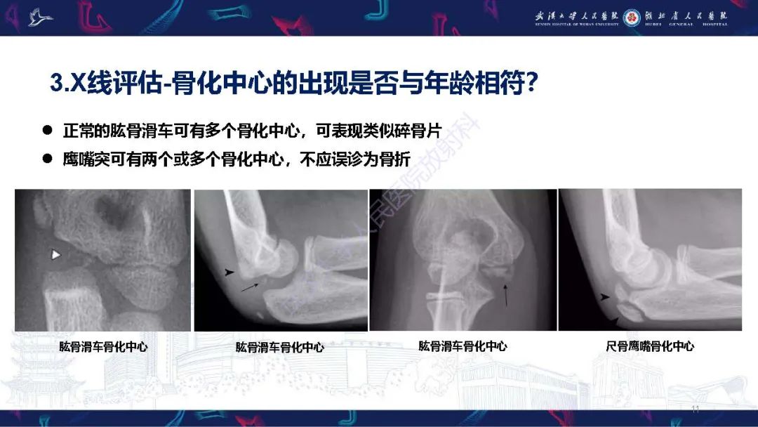 影像PPT - 【PPT】儿童肘关节外伤X线诊断-11