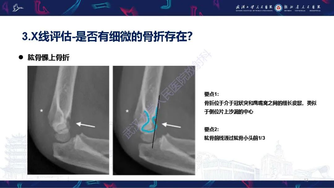 影像PPT - 【PPT】儿童肘关节外伤X线诊断-13