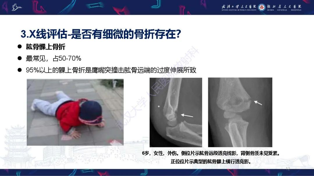 影像PPT - 【PPT】儿童肘关节外伤X线诊断-12