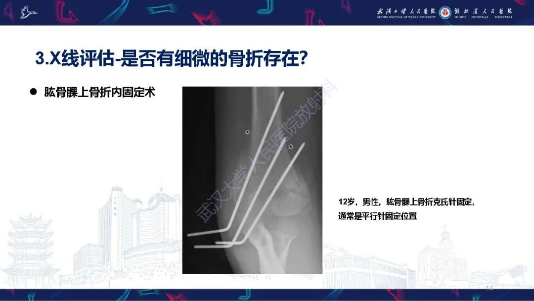 影像PPT - 【PPT】儿童肘关节外伤X线诊断-14