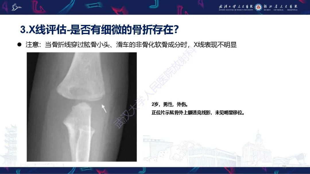 影像PPT - 【PPT】儿童肘关节外伤X线诊断-16