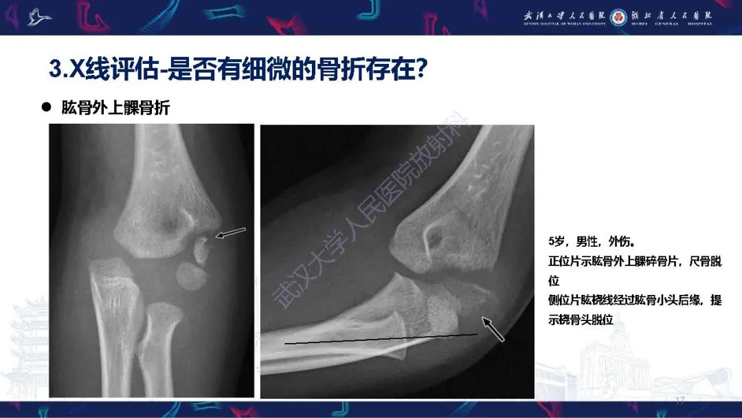 影像PPT - 【PPT】儿童肘关节外伤X线诊断-17