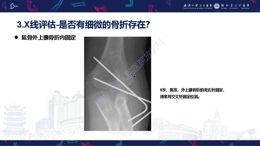 影像PPT - 【PPT】儿童肘关节外伤X线诊断-18