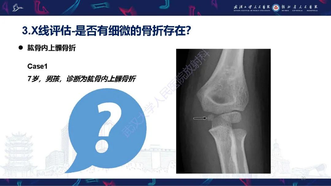 影像PPT - 【PPT】儿童肘关节外伤X线诊断-20