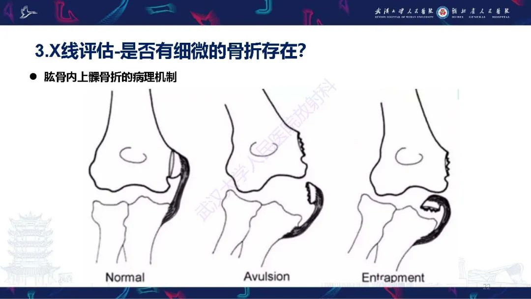 影像PPT - 【PPT】儿童肘关节外伤X线诊断-22