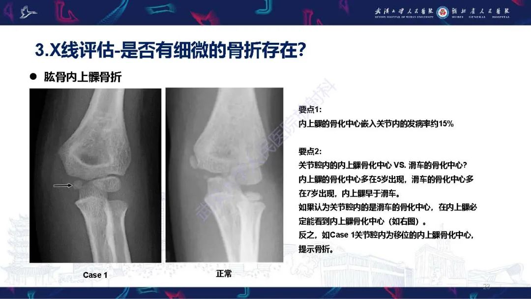 影像PPT - 【PPT】儿童肘关节外伤X线诊断-23