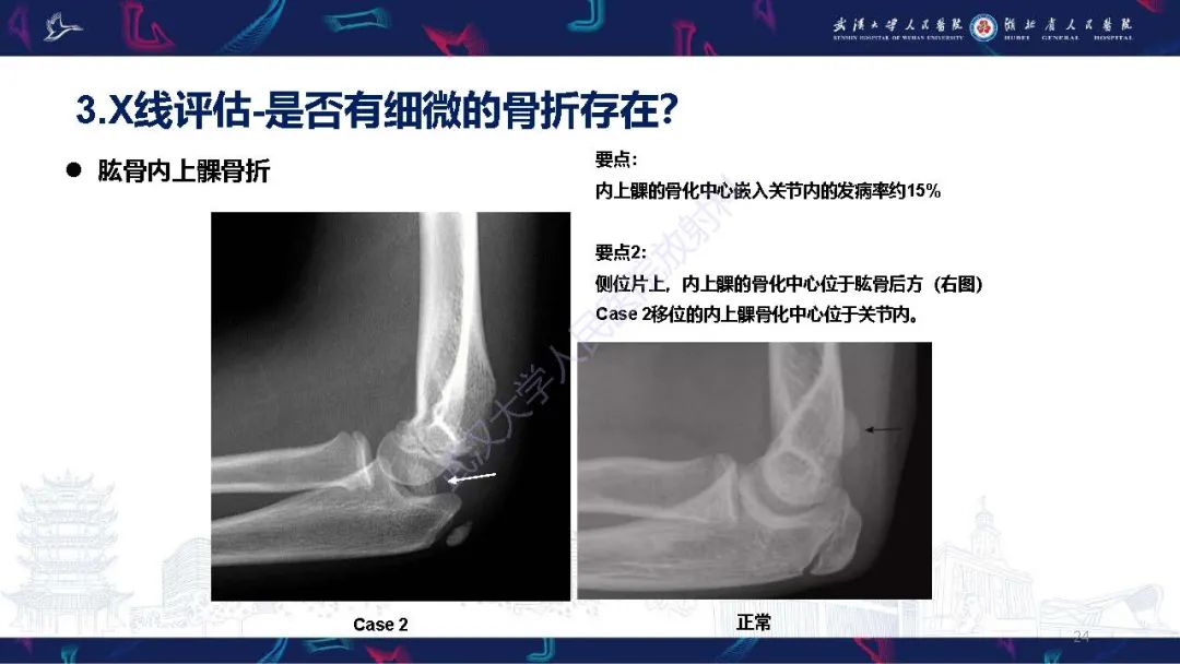 影像PPT - 【PPT】儿童肘关节外伤X线诊断-24