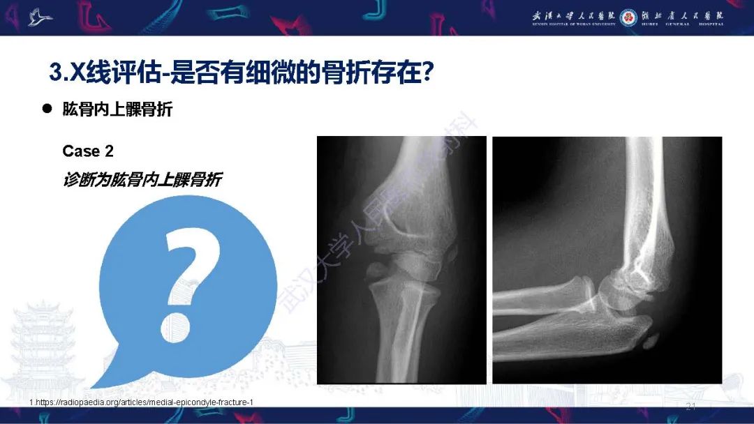 影像PPT - 【PPT】儿童肘关节外伤X线诊断-21