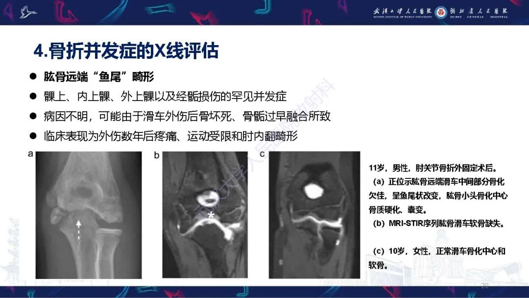 影像PPT - 【PPT】儿童肘关节外伤X线诊断-29