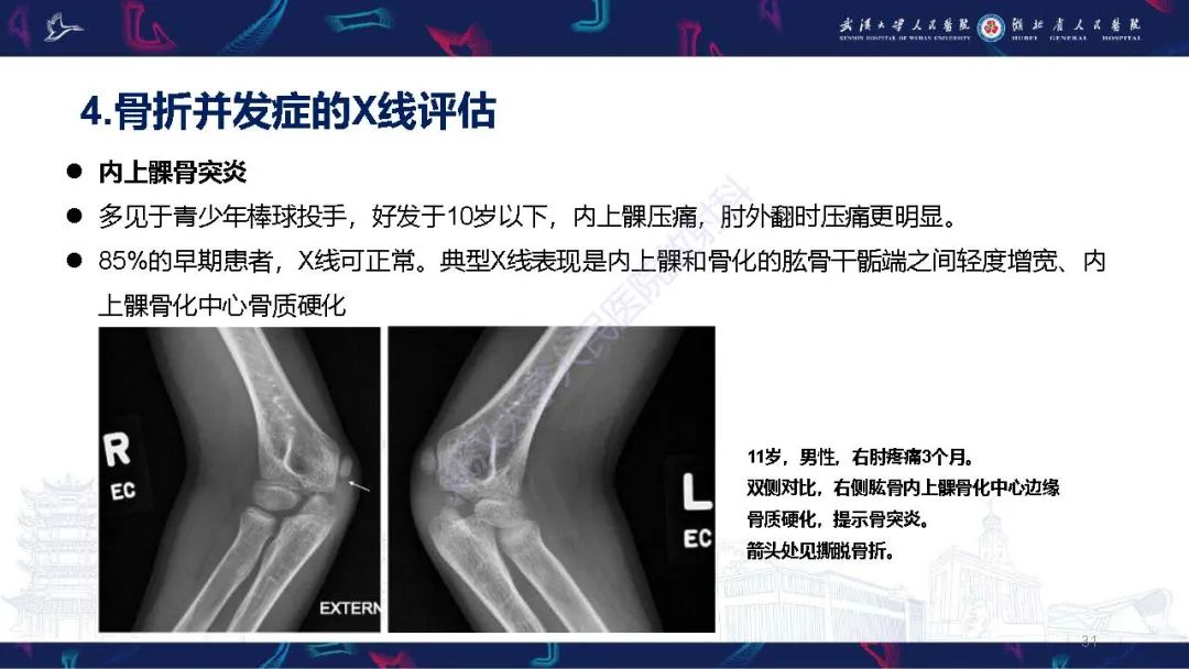 影像PPT - 【PPT】儿童肘关节外伤X线诊断-31