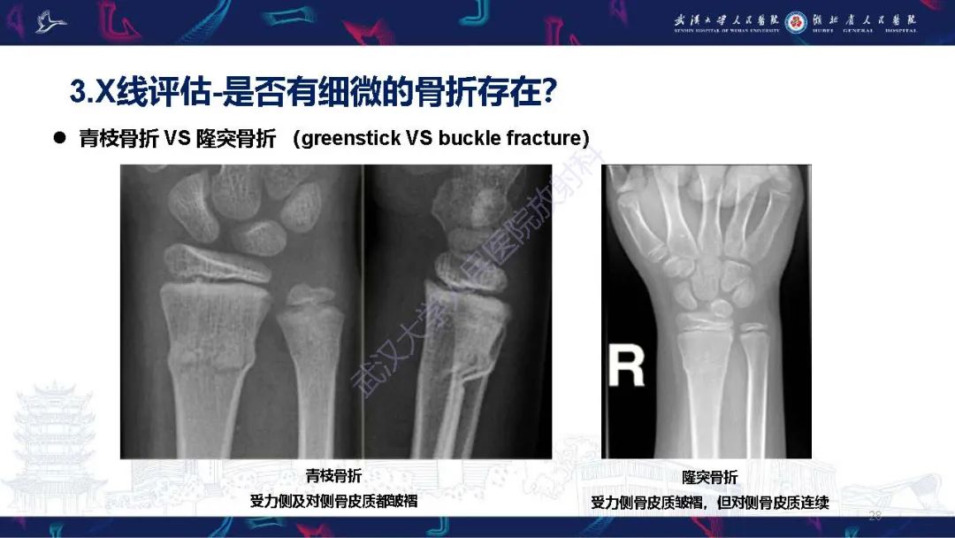 影像PPT - 【PPT】儿童肘关节外伤X线诊断-28