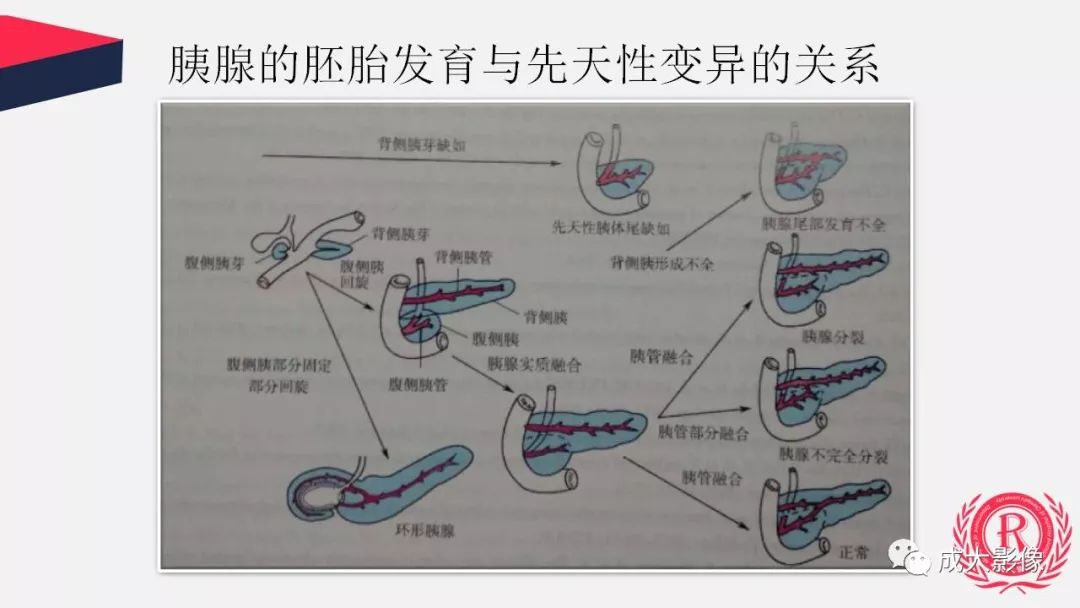 影像PPT - 【PPT】胰腺变异影像学诊断-5