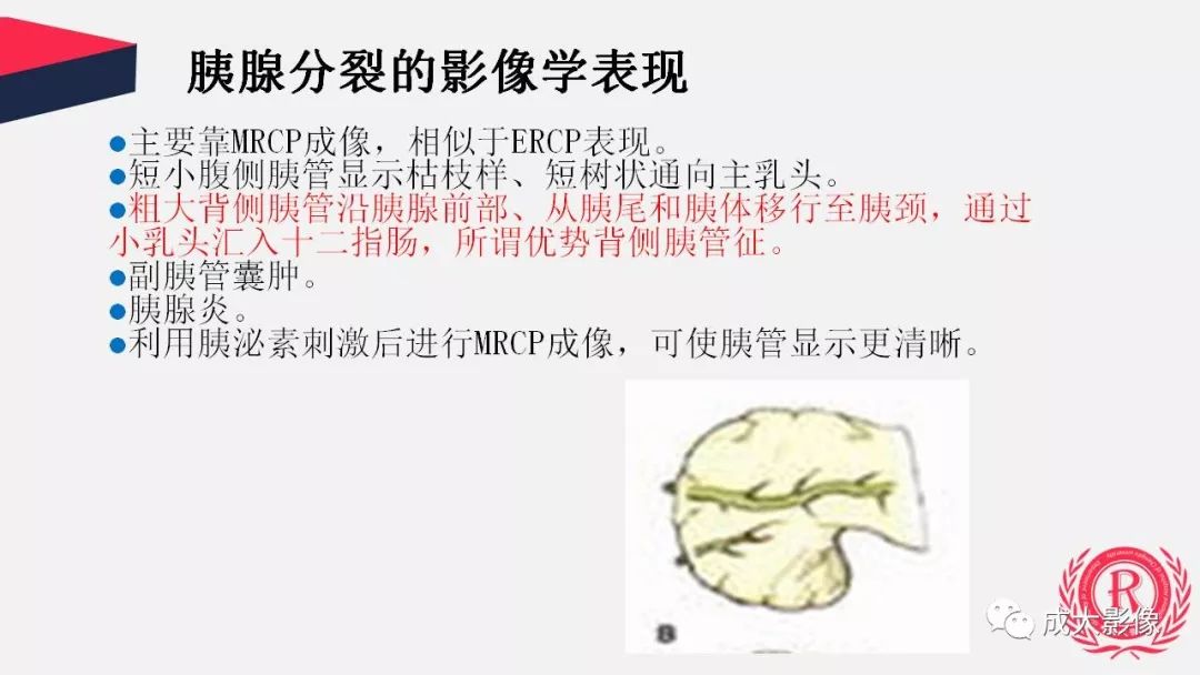 影像PPT - 【PPT】胰腺变异影像学诊断-11