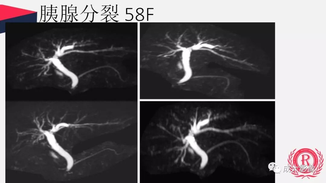 影像PPT - 【PPT】胰腺变异影像学诊断-12