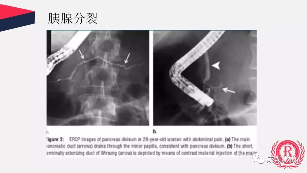 影像PPT - 【PPT】胰腺变异影像学诊断-14