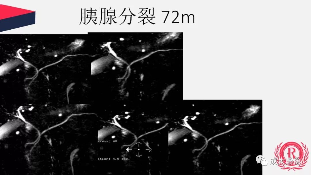 影像PPT - 【PPT】胰腺变异影像学诊断-13