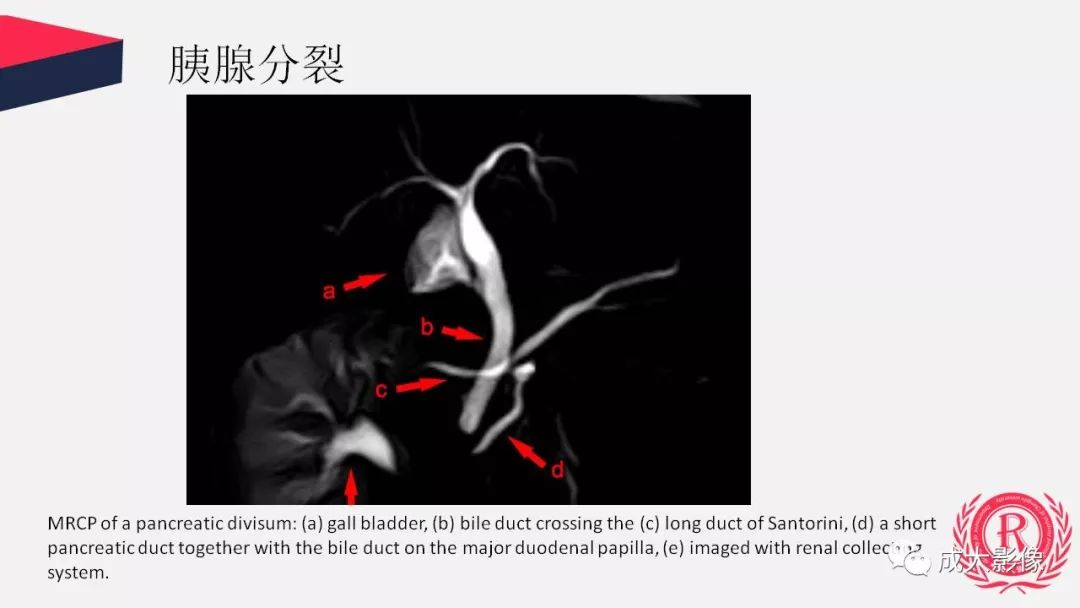 影像PPT - 【PPT】胰腺变异影像学诊断-15