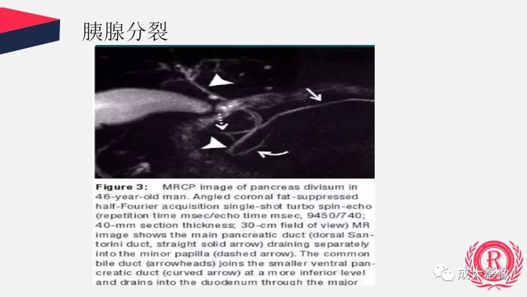 影像PPT - 【PPT】胰腺变异影像学诊断-16