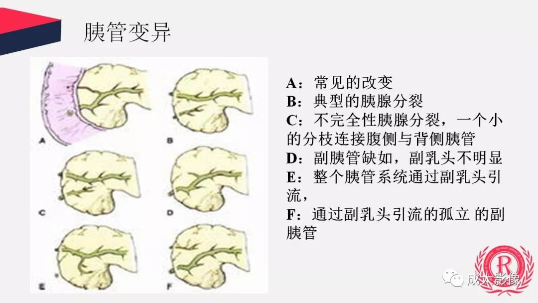 影像PPT - 【PPT】胰腺变异影像学诊断-8