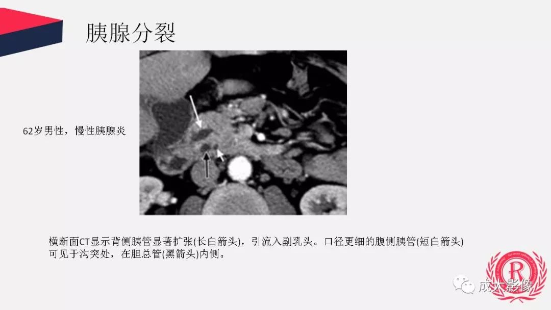 影像PPT - 【PPT】胰腺变异影像学诊断-18