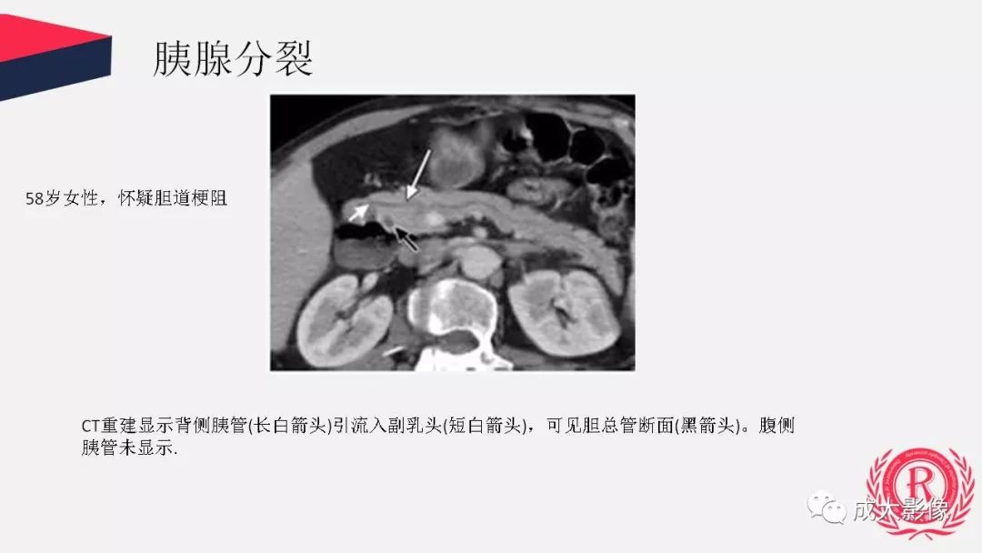 影像PPT - 【PPT】胰腺变异影像学诊断-19