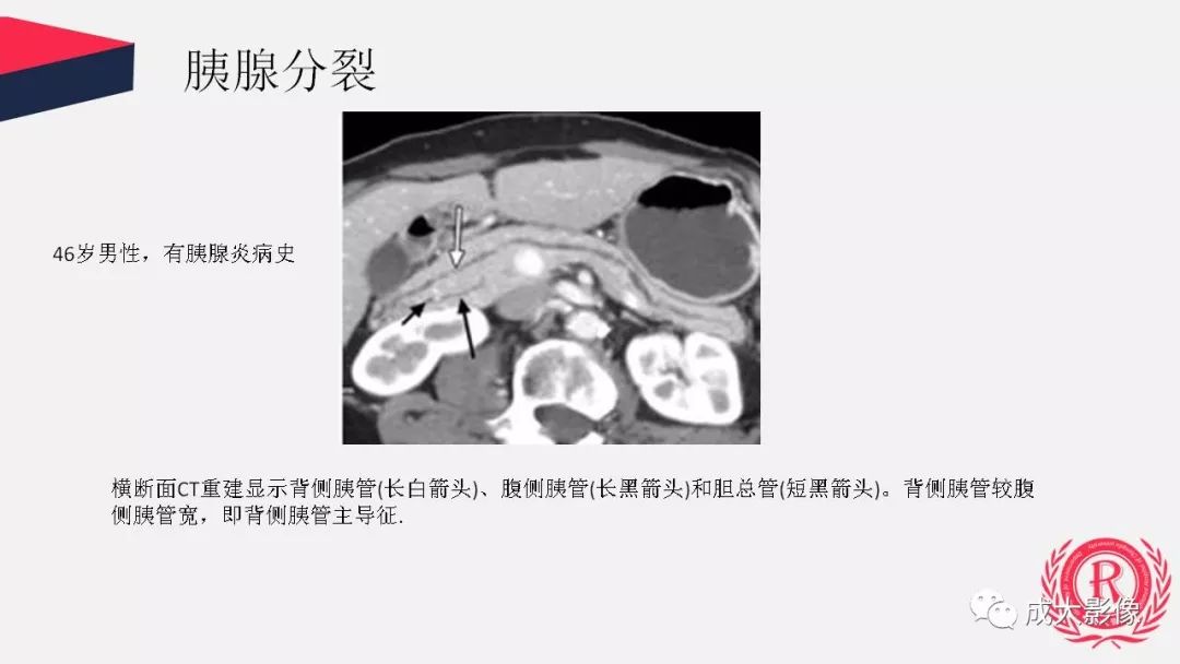 影像PPT - 【PPT】胰腺变异影像学诊断-17