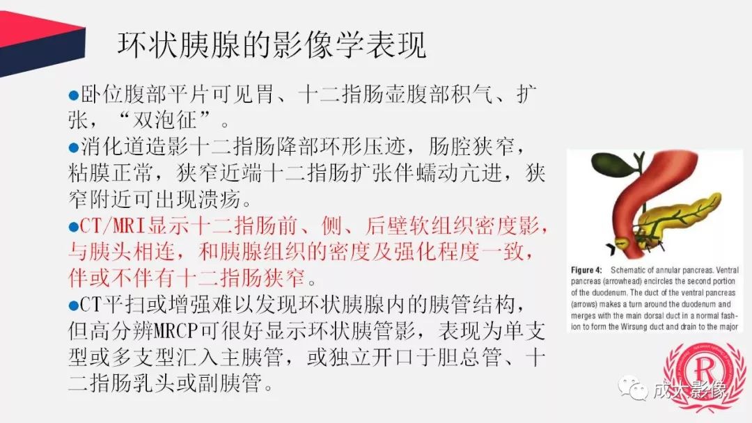 影像PPT - 【PPT】胰腺变异影像学诊断-31