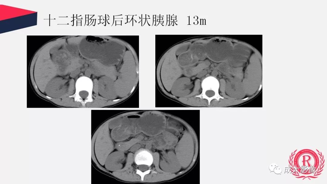 影像PPT - 【PPT】胰腺变异影像学诊断-35